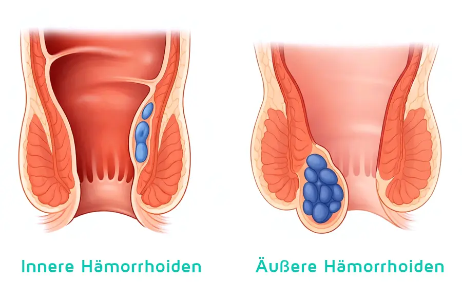 äußere hämorrhoiden und innere